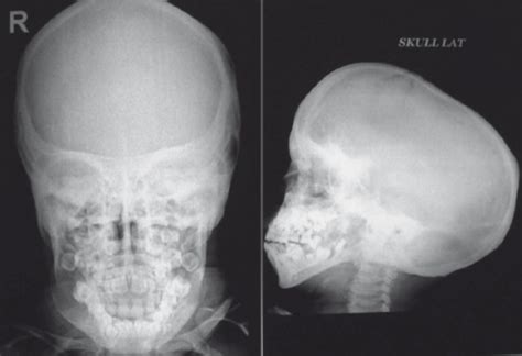 Radiographic Examination Pa And Lateral View Of The S Open I