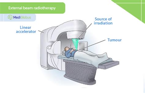 radiation therapy  metastases medical tourism  mediglobus