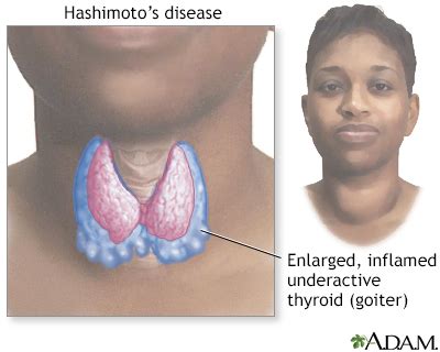 goiter on thyroid - Deanne Stageman