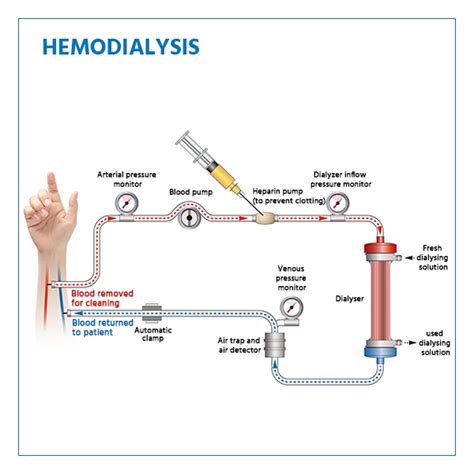 hemodialysis steps procedure recovery