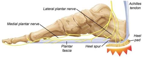 PLANTAR FASCIITIS (HEEL PAIN) - UDAI OMNI HOSPITAL