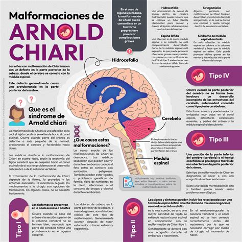 Neuralgia De Arnold 4