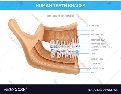 Human teeth braces realistic infographics Vector Image