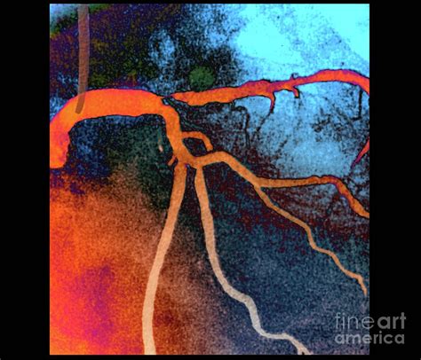 coronary artery stenosis photograph  zephyrscience photo library