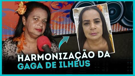 Gaga de Ilhéus faz harmonização facial e resultado surpreende YouTube