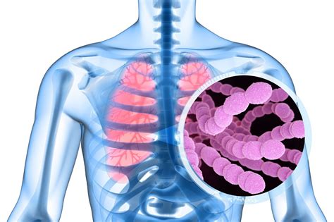 Pneumococco Sintomi Cura E Vaccino Ohga