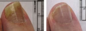 Costa Mesa Laser Toenail Fungus Treatment | Jeffrey Kleis DPM, Inc.