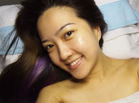 Hot girl khốn khổ vì mụn do làm đẹp