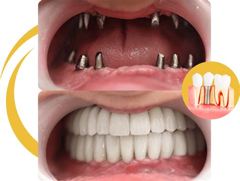Dental Implants Turkey | Dental Implants Before & After