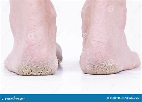 diabetic foot feet cracked heels legs   person stock photo image