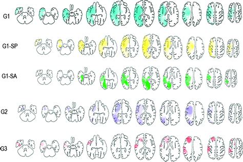 The neuroanatomy of asomatognosia and somatoparaphrenia | Journal of