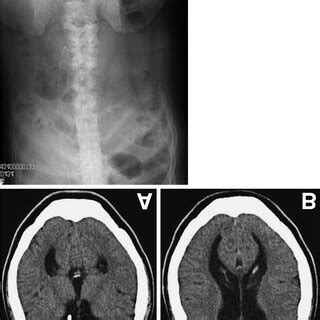 A B Computed Tomography Scans At The Second Consultation Showing