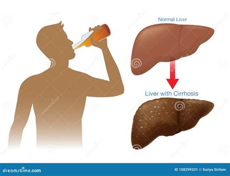 Liver Cirrhosis Alcohol