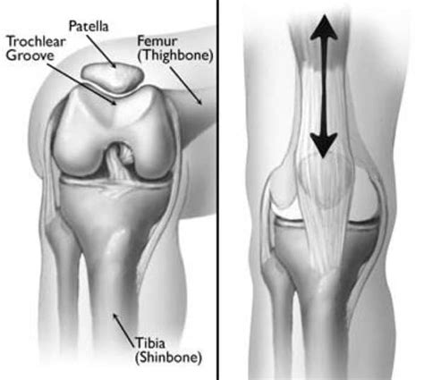 Patellar dislocation treatment with 3 exercises for recovery