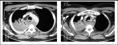 Pdf Posterior Mediastinal Abscess Secondary To Esophageal Perforation