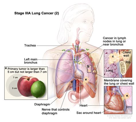 Stage 3 Non-Small Cell Lung Cancer Diagnosis, Treatment and Payment ...