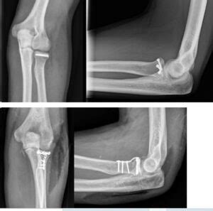 Radial Head Fracture Treatment in Abu Dhabi | UAE