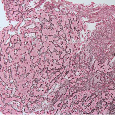 A Liver Biopsy Performed In September 2006 Shows In The Reticulin Stain