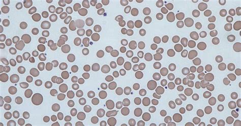 Anisocytosis: Types, Causes, Symptoms, Diagnosis