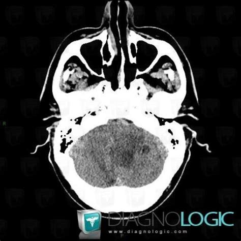 Cas Radiologie M Tastase Scanner Irm Diagnologic