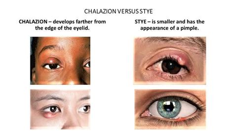 Chalazion vs Stye in 2024 | Eye facts, Medical studies, Health and ...