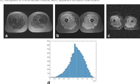 Figure From Histogram Analysis Derived From Apparent Diffusion