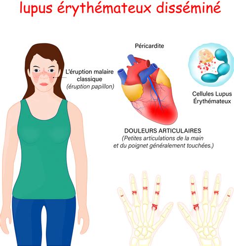 Lupus Causes Sympt Mes Et Esp Rance De Vie Information