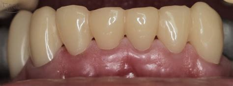 fabrication  long term provisional fixed tooth restorations