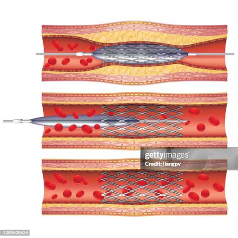 coronary stent stock  high res pictures  images getty