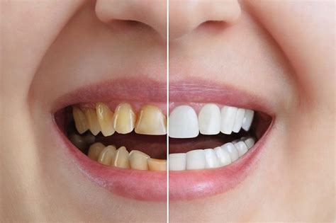 Pod Amarela Os Dentes - Benestar Odontologia | Dentes amarelados, como prevenir e como clarear?