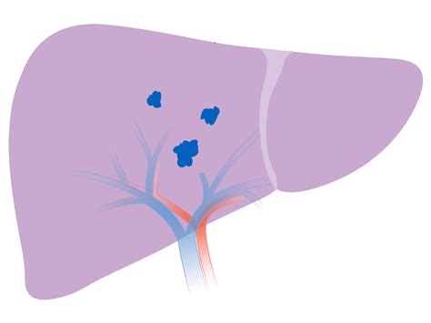 New Insights On Liver Transplants For People With Liver Cancer Nci