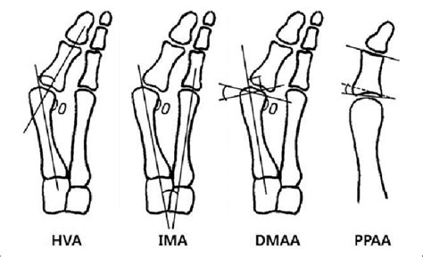 Radiographic Parameter Of The Hallux Valgus Dmaa Distal Metatarsal