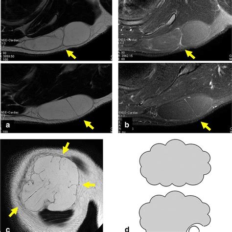 A 37 Year Old Man With A Shoulder Lipoma The Lipoma Is Characterized Download Scientific