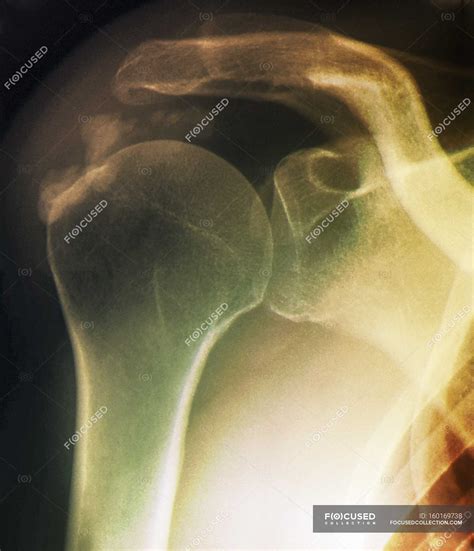 Tendinitis of the shoulder — cuff, x ray - Stock Photo | #160169738