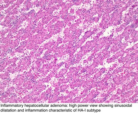 Pathology Outlines - Hepatocellular adenoma