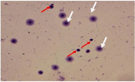 Photomicrograph Showed Sperms With Fragmented Dna Red Arrow And