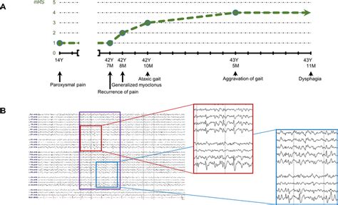 Clinical Course And Electroencephalography Eeg A The Disease