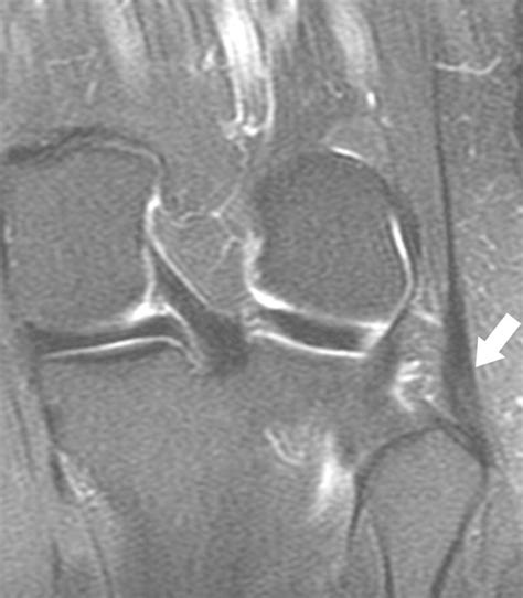 Popliteofibular Ligament Mri