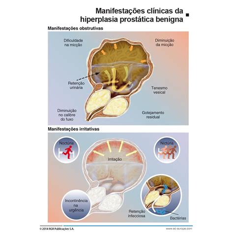 Hiperplasia Prostática O Que É - Hiperplasia prostática benigna (HPB)