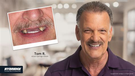 Before And After Results Grace Dental Framingham Ma