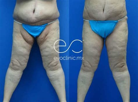 Thigh Lift Before And After Evoclinic