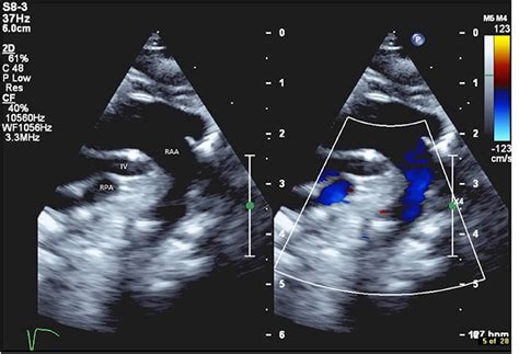 Frontiers Tetralogy Of Fallot With Right Aortic Arch And Retro Aortic Innominate Vein