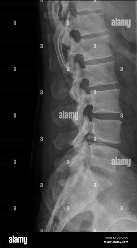 Human Lumbar Spine X Ray Side View Stock Photo Alamy