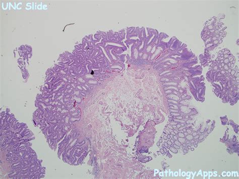 Adenoma Pathology