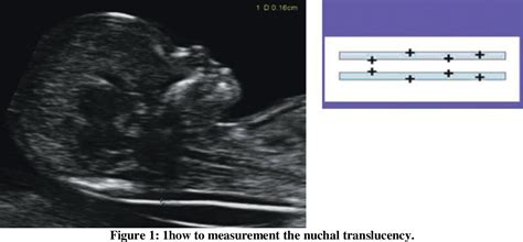 Figure 1 From Variation Of Nuchal Translucency Measurement In First