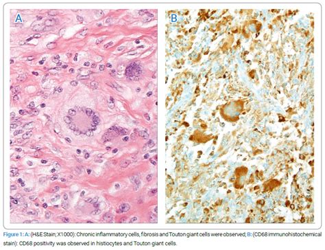 Erdheim Chester Disease Clinically Mimicking Omental Carcinomatosis