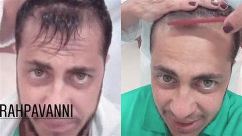 Thammy Miranda Faz Tratamento Para Calv Ce Cuidar Da Careca