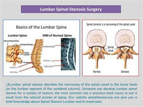 PPT - Lumbar Spinal Stenosis Surgery PowerPoint Presentation, free ...