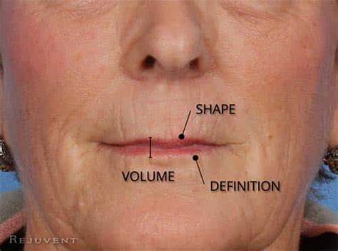 Lip Enhancement with Injectable Fillers • Rejuvent Scottsdale