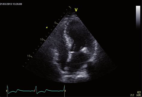 Echocardiography Showing Septal Hypertrophy In A Patient With Hcm Download Scientific Diagram